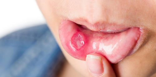 Oral Cancer Treatment in Nagpur