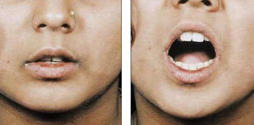 Oral Submucous Fibrosis Surgery in Nagpur