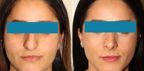 Nasal Deformity (Rhinoplasty) Surgery in Nagpur